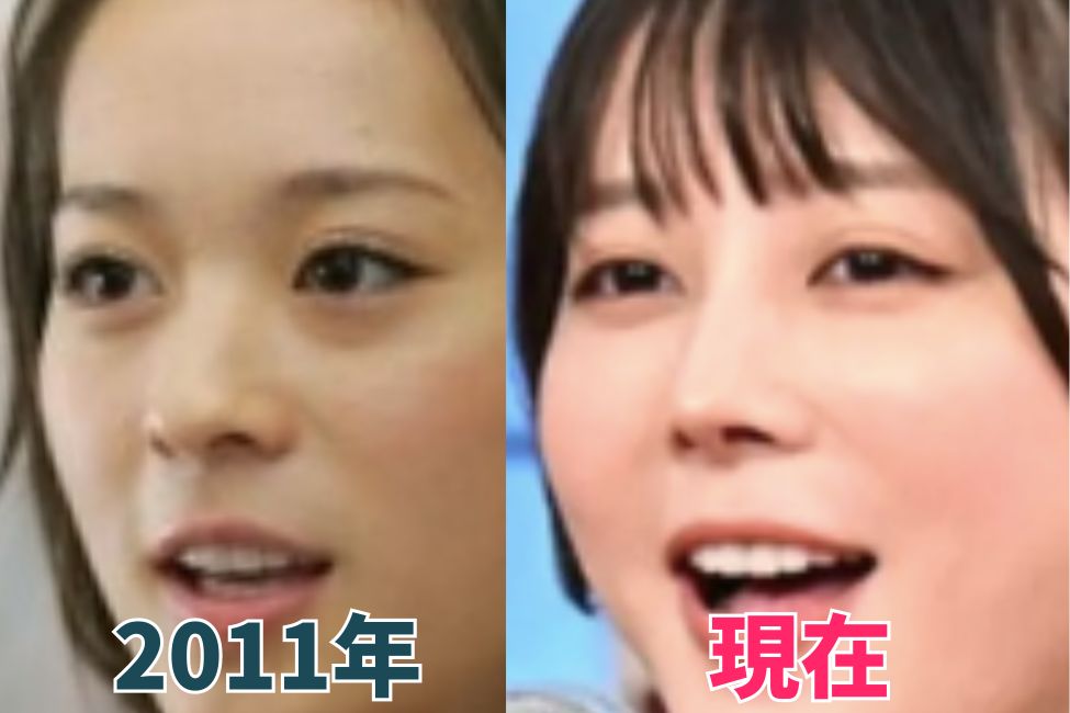 北乃きいさんの鼻を昔の画像と比較