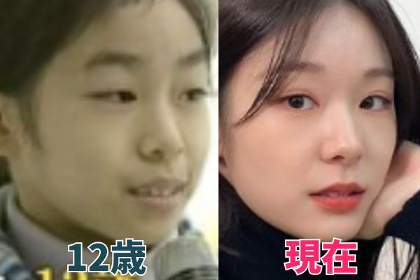 キムヨナさんの鼻を昔の画像と比較