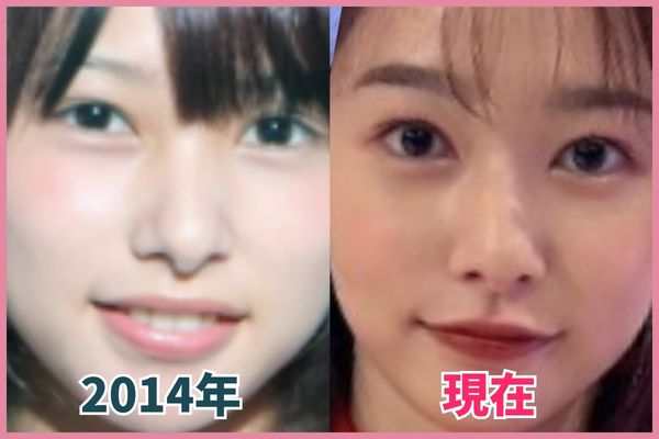 桜井日奈子さんの鼻を昔の画像と比較