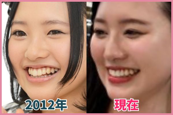 兒玉遥さんの鼻を昔の画像と比較