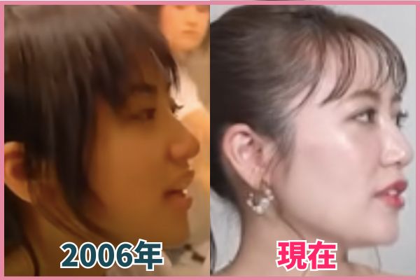 高橋みなみさんの鼻を昔の画像と比較