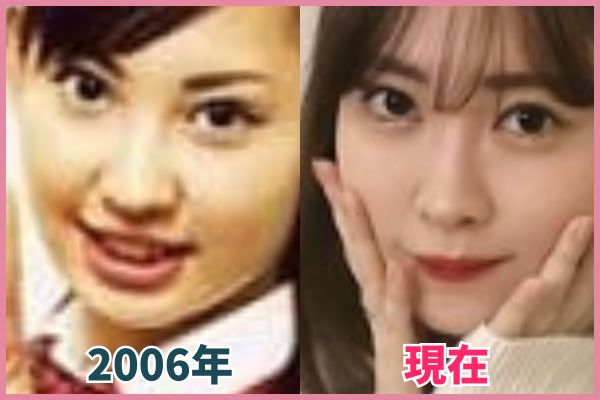 小嶋陽菜さんの鼻を昔の画像と比較